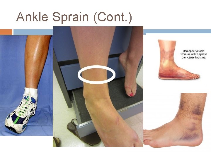 Ankle Sprain (Cont. ) 