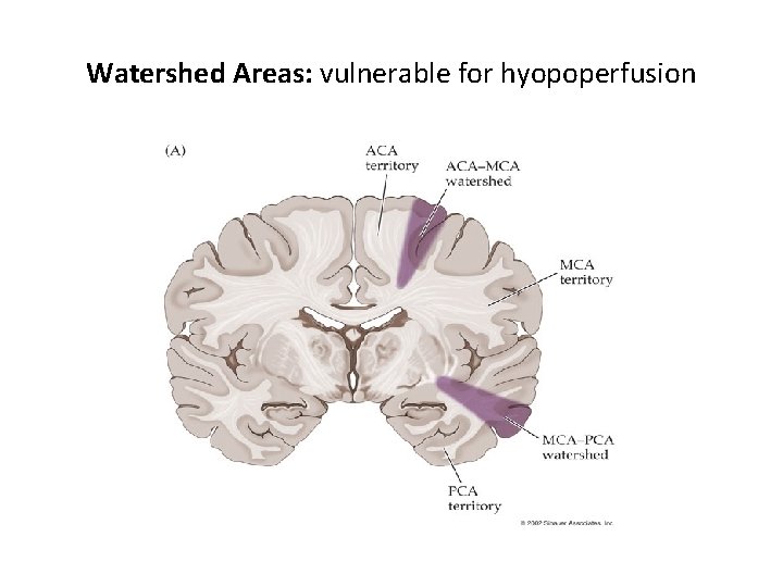 Watershed Areas: vulnerable for hyopoperfusion 