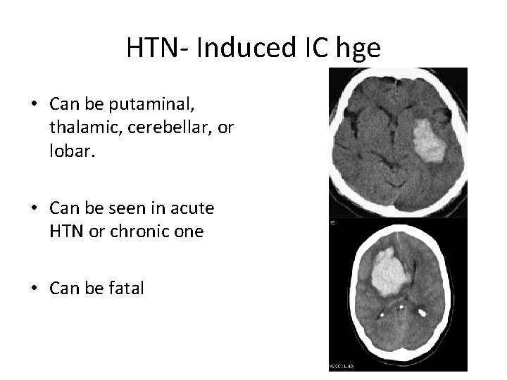 HTN- Induced IC hge • Can be putaminal, thalamic, cerebellar, or lobar. • Can