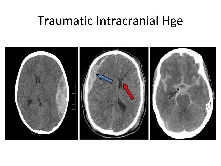 Traumatic Intracranial Hge 