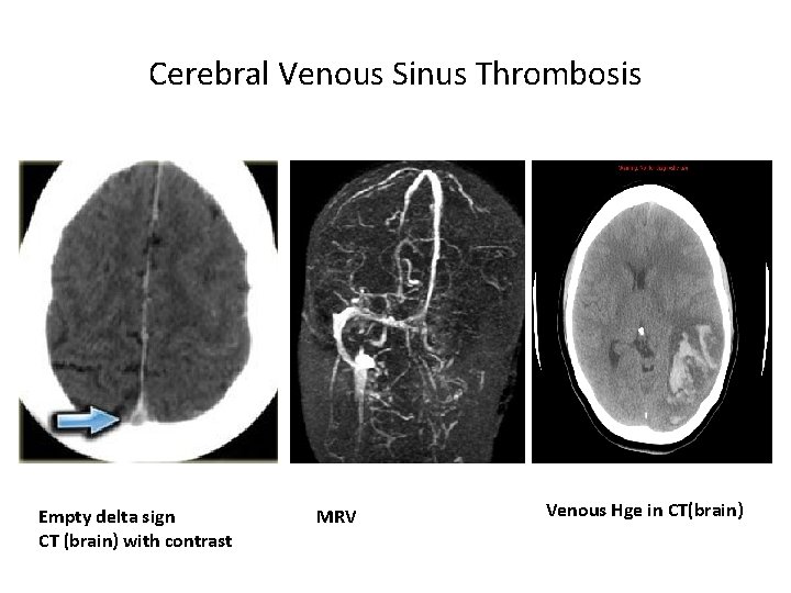 Cerebral Venous Sinus Thrombosis Empty delta sign CT (brain) with contrast MRV Venous Hge