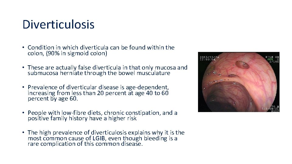 Diverticulosis • Condition in which diverticula can be found within the colon, (90% in