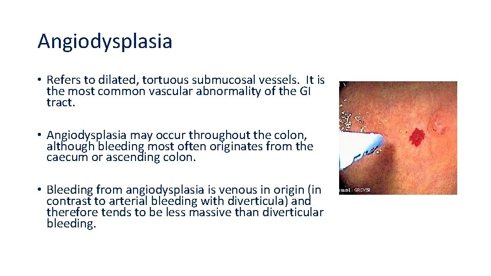 Angiodysplasia • Refers to dilated, tortuous submucosal vessels. It is the most common vascular