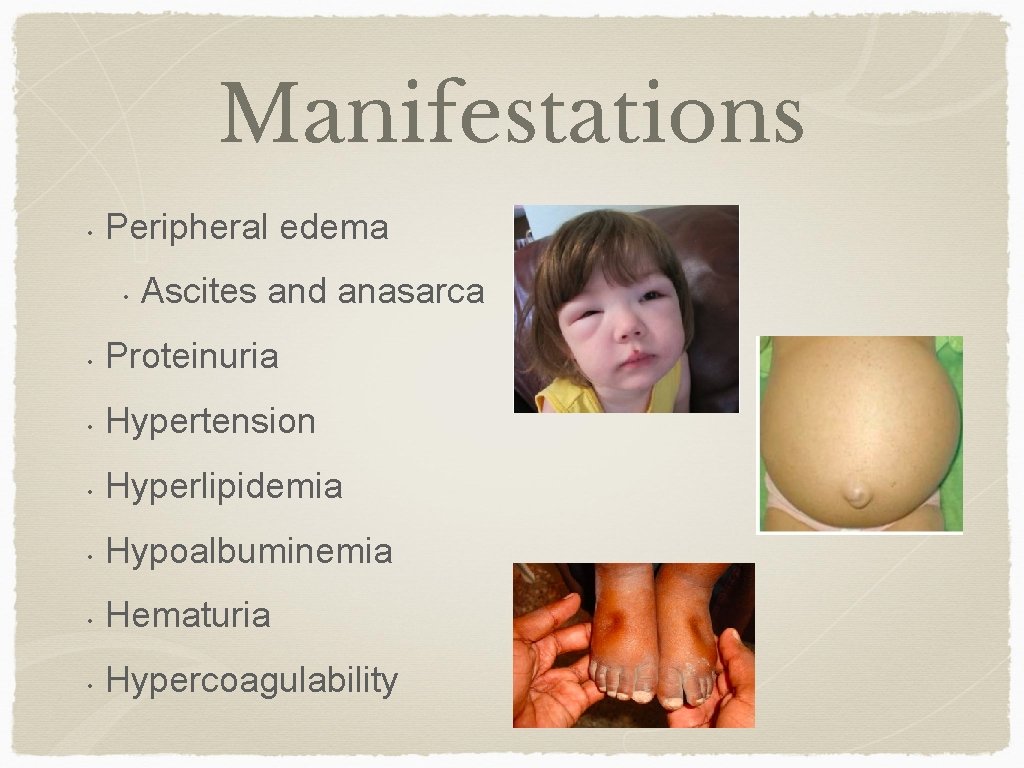 Manifestations • Peripheral edema • Ascites and anasarca • Proteinuria • Hypertension • Hyperlipidemia