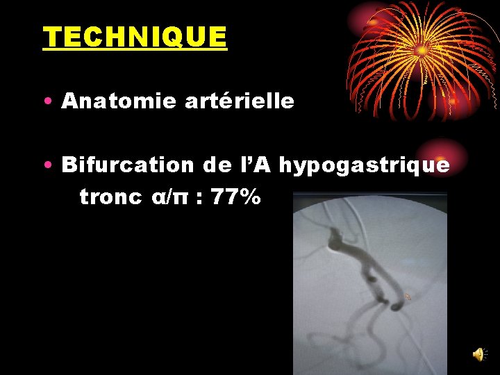 TECHNIQUE • Anatomie artérielle • Bifurcation de l’A hypogastrique tronc α/π : 77% 