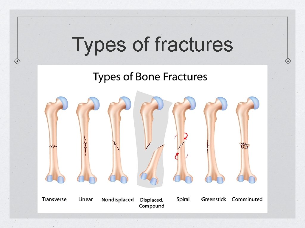 Types of fractures 