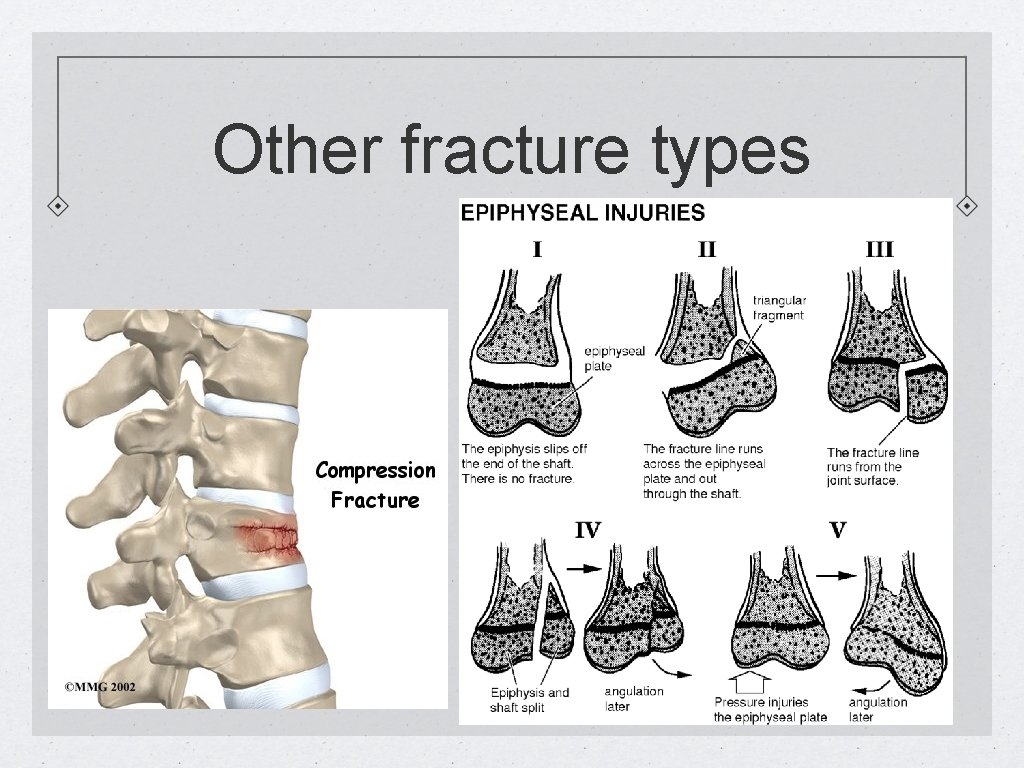 Other fracture types 