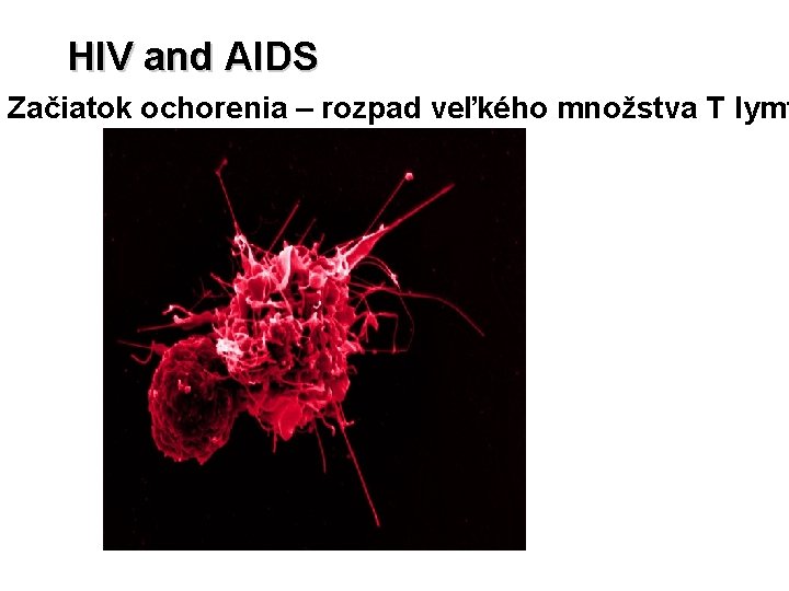 HIV and AIDS Začiatok ochorenia – rozpad veľkého množstva T lymf 