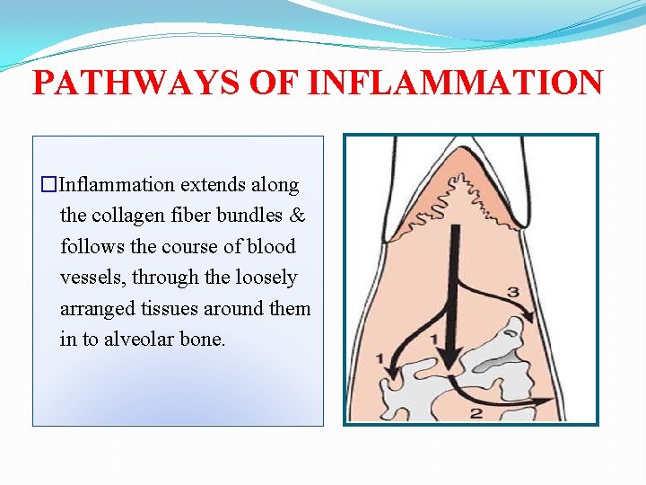 PATHWAYS OF INFLAMMATION �Inflammation extends along the collagen fiber bundles & follows the course