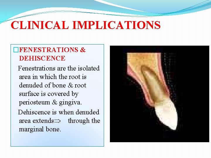 CLINICAL IMPLICATIONS �FENESTRATIONS & DEHISCENCE Fenestrations are the isolated area in which the root