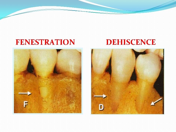 FENESTRATION DEHISCENCE 