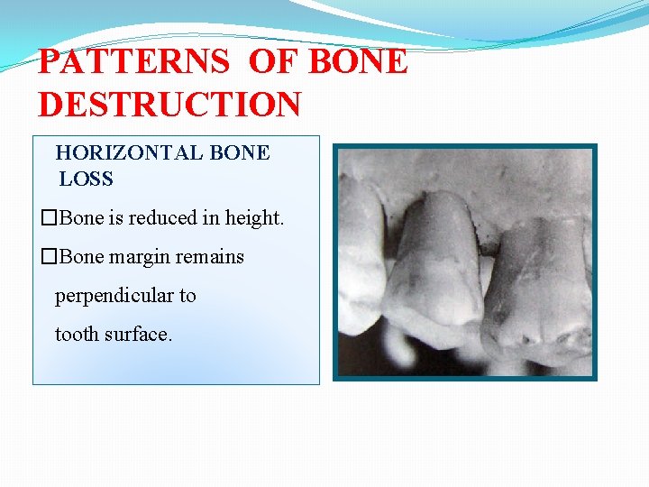 PATTERNS OF BONE DESTRUCTION HORIZONTAL BONE LOSS �Bone is reduced in height. �Bone margin