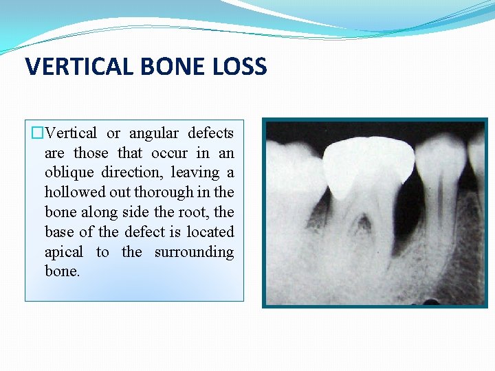 VERTICAL BONE LOSS �Vertical or angular defects are those that occur in an oblique