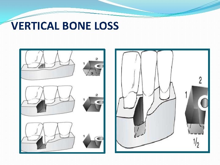 VERTICAL BONE LOSS 