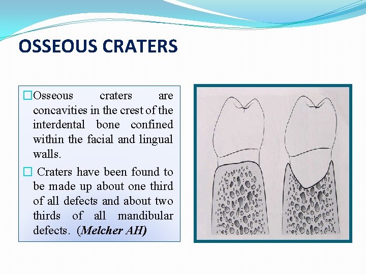 OSSEOUS CRATERS �Osseous craters are concavities in the crest of the interdental bone confined