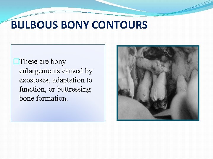 BULBOUS BONY CONTOURS �These are bony enlargements caused by exostoses, adaptation to function, or