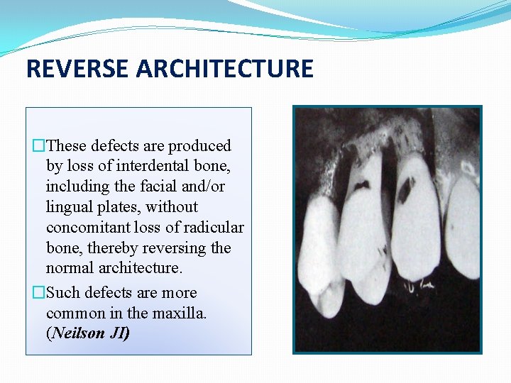 REVERSE ARCHITECTURE �These defects are produced by loss of interdental bone, including the facial