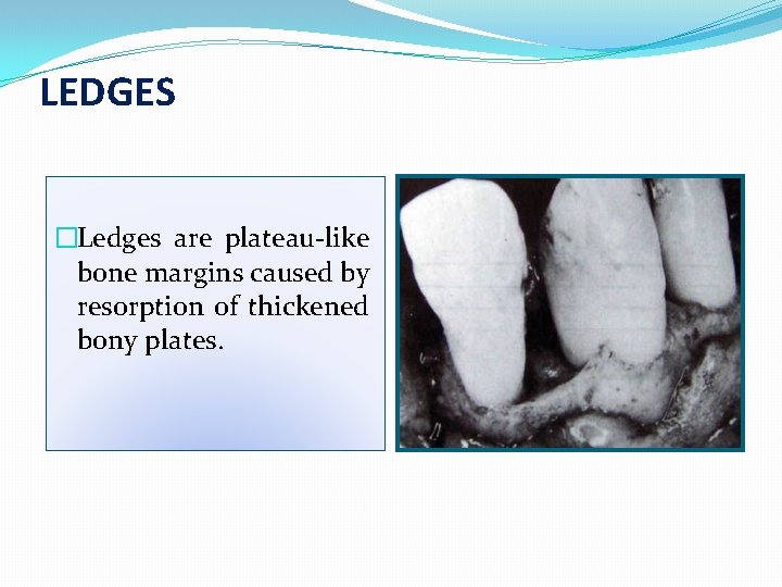 LEDGES �Ledges are plateau-like bone margins caused by resorption of thickened bony plates. 