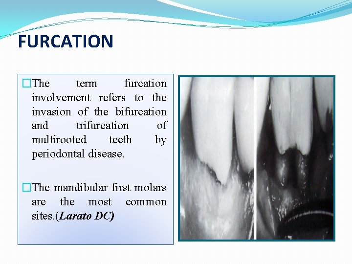 FURCATION �The term furcation involvement refers to the invasion of the bifurcation and trifurcation