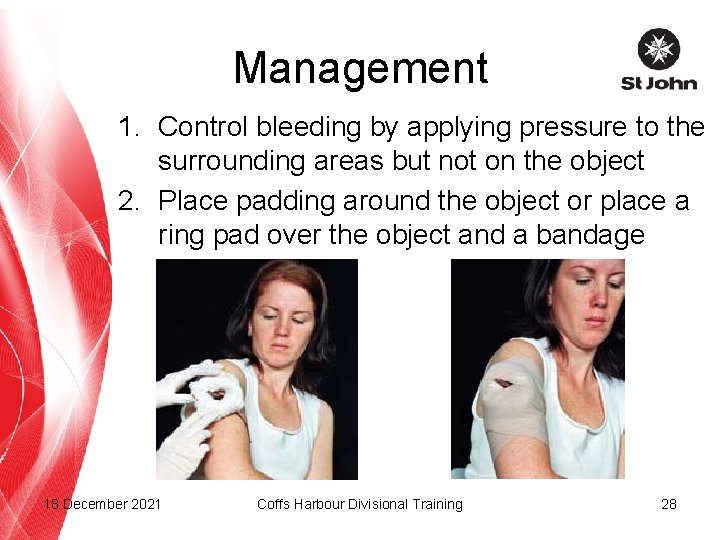 Management 1. Control bleeding by applying pressure to the surrounding areas but not on