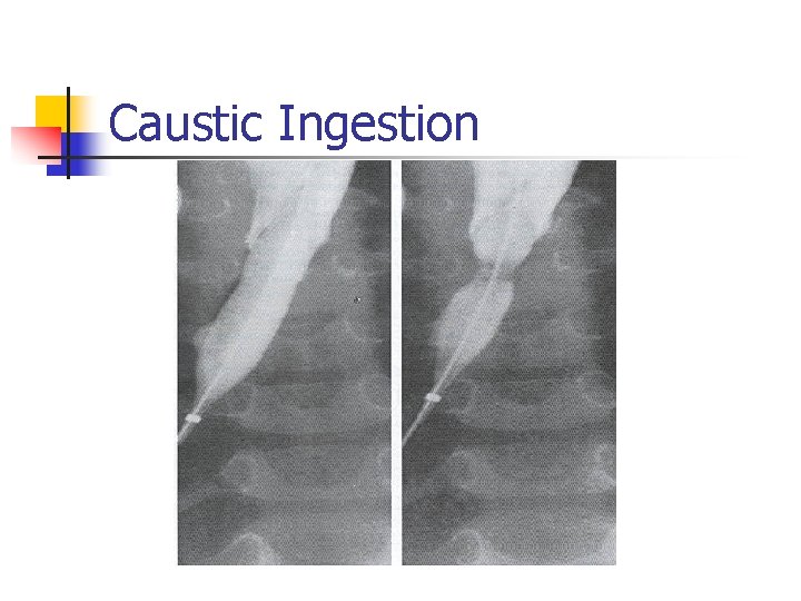 Caustic Ingestion 