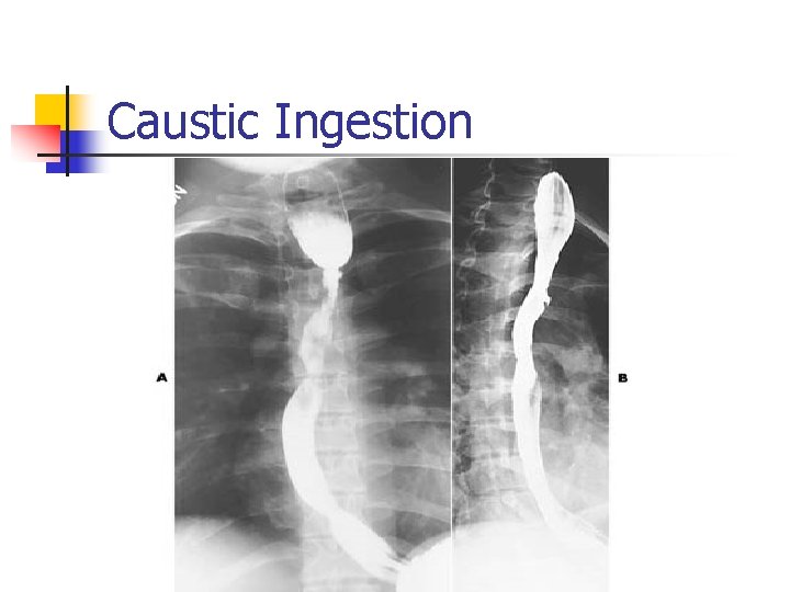 Caustic Ingestion 