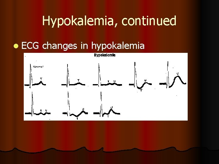 Hypokalemia, continued l ECG changes in hypokalemia Hypokalemia, continued l ECG changes in hypokalemia