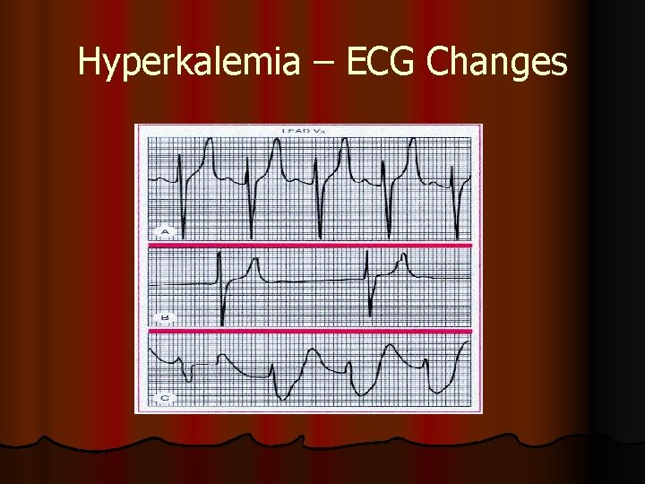 Hyperkalemia – ECG Changes Hyperkalemia – ECG Changes