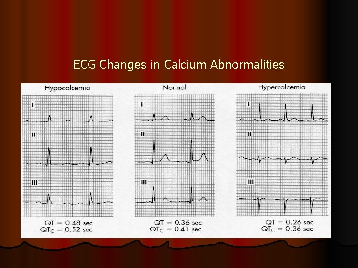 ECG Changes in Calcium Abnormalities ECG Changes in Calcium Abnormalities