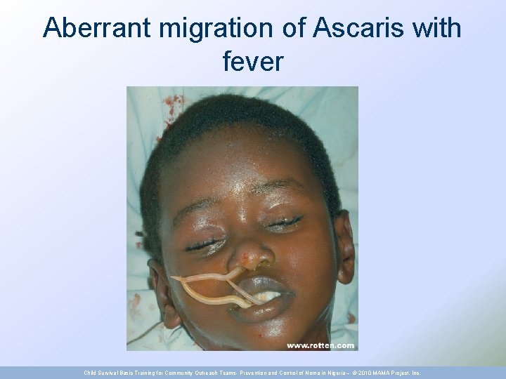 Aberrant migration of Ascaris with fever Child Survival Basic Training for Community Outreach Teams-