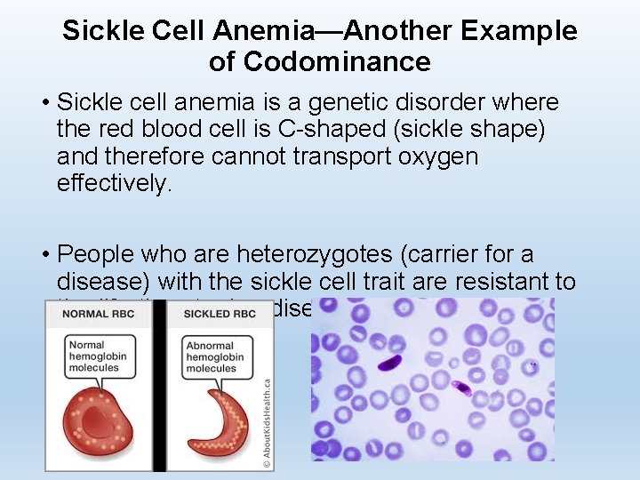 Sickle Cell Anemia—Another Example of Codominance • Sickle cell anemia is a genetic disorder