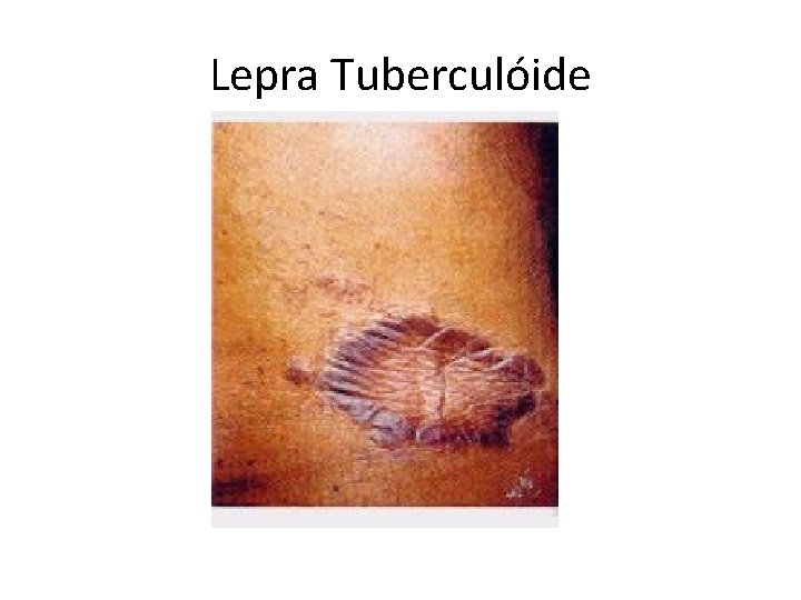 Lepra Tuberculóide 