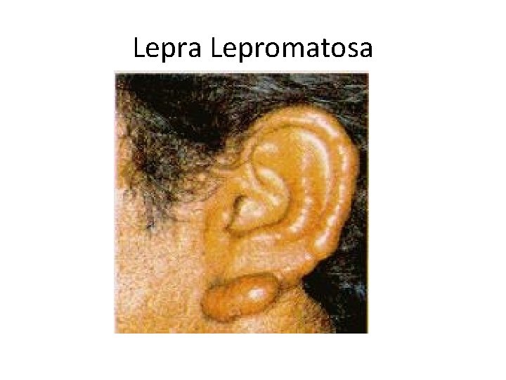 Lepra Lepromatosa 