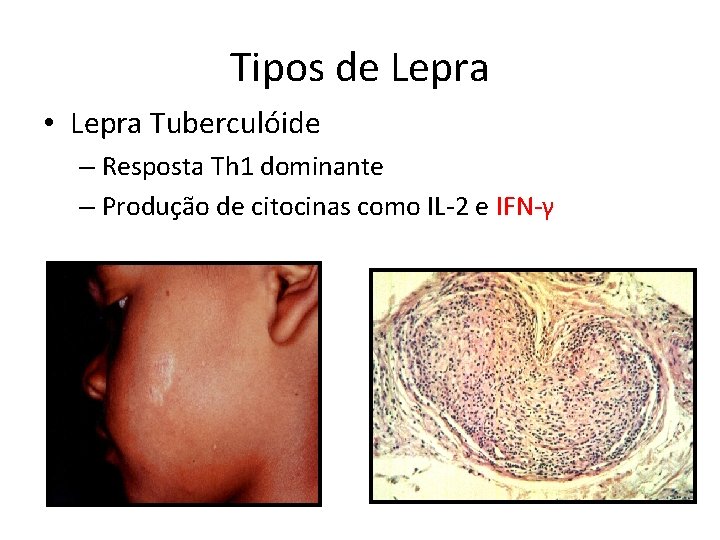 Tipos de Lepra • Lepra Tuberculóide – Resposta Th 1 dominante – Produção de