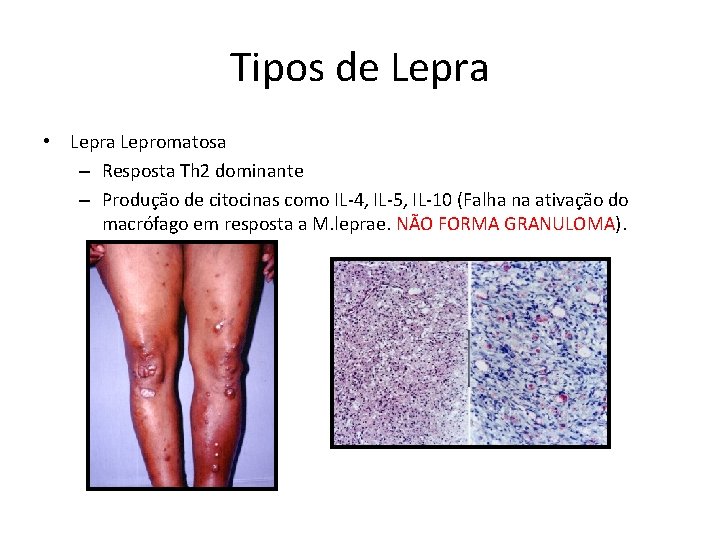 Tipos de Lepra • Lepra Lepromatosa – Resposta Th 2 dominante – Produção de