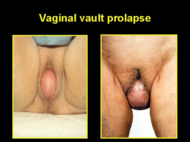 Vaginal vault prolapse 