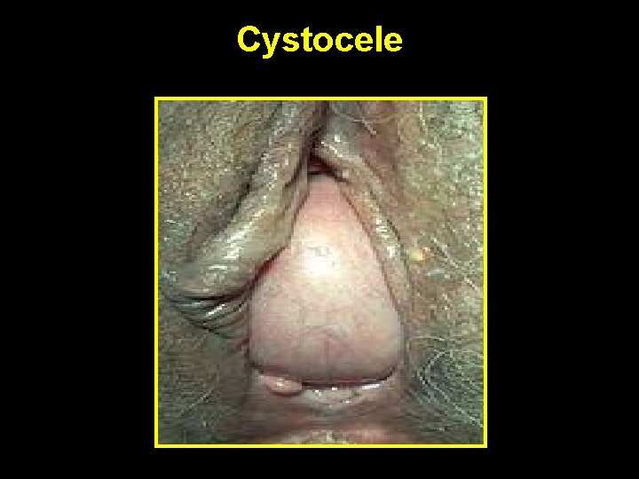 Cystocele 