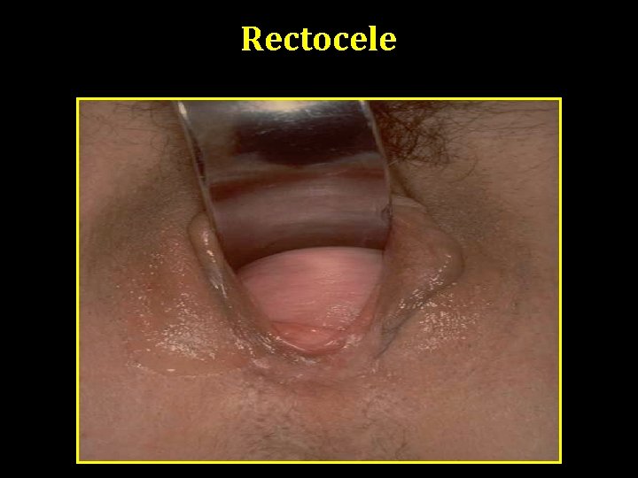 Rectocele Cystocele 