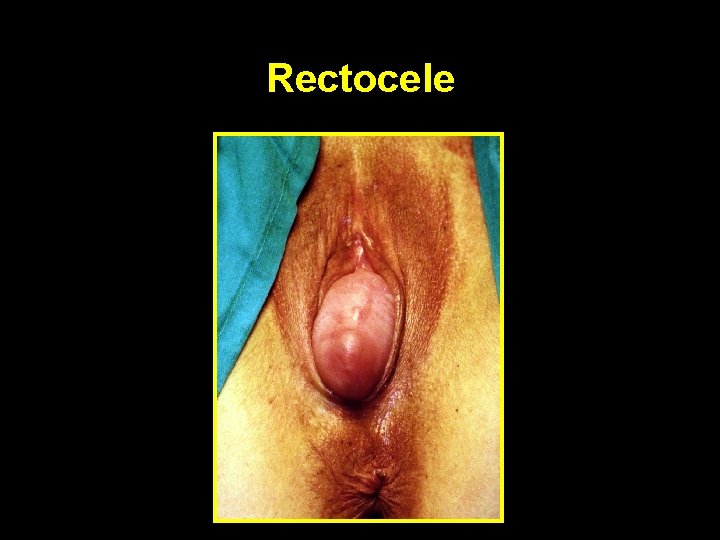 Rectocele 