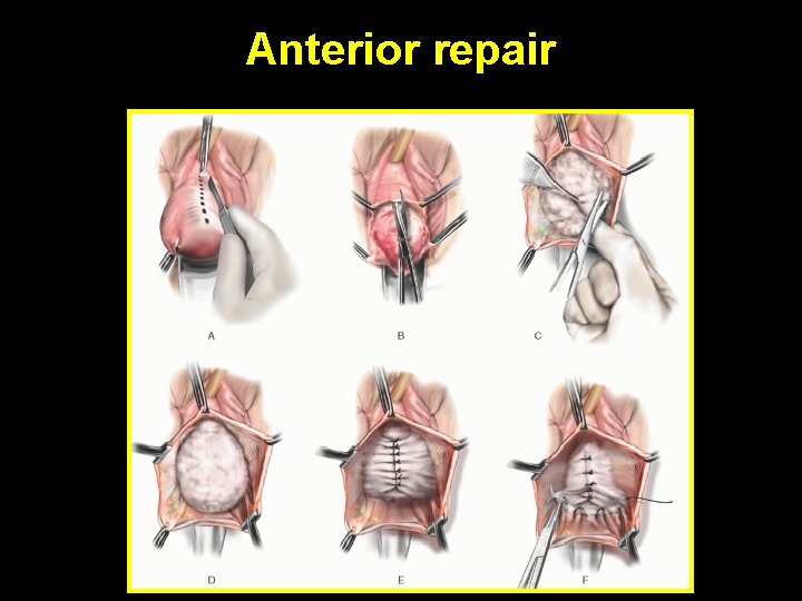 Anterior repair 