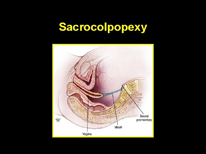 Sacrocolpopexy 