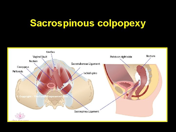 Sacrospinous colpopexy 