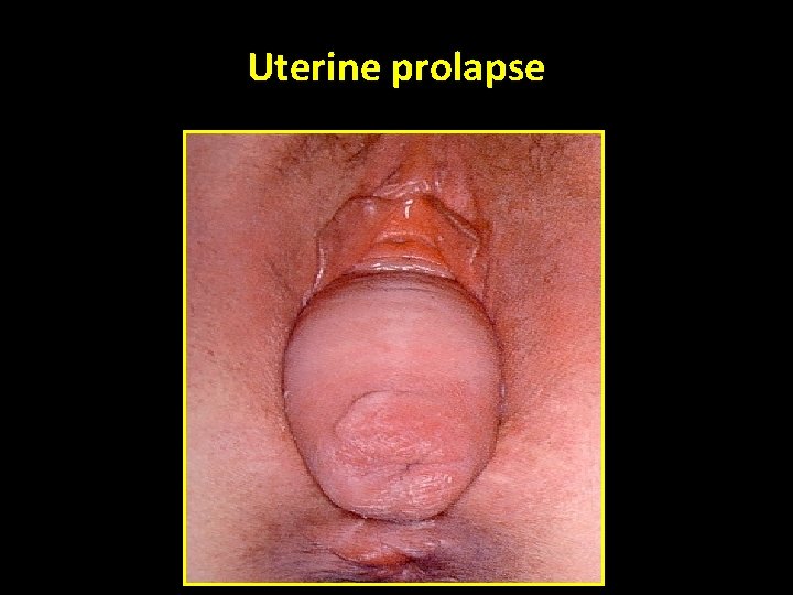 Uterine prolapse 