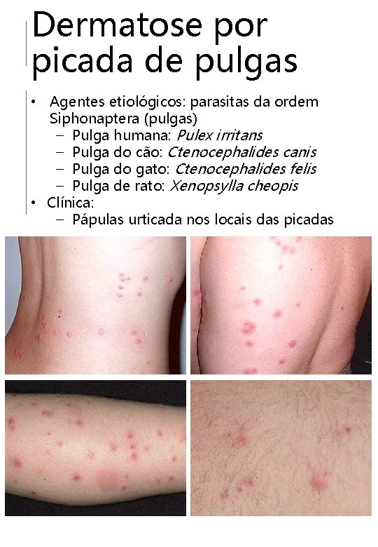 Dermatose por picada de pulgas • Agentes etiológicos: parasitas da ordem Siphonaptera (pulgas) –