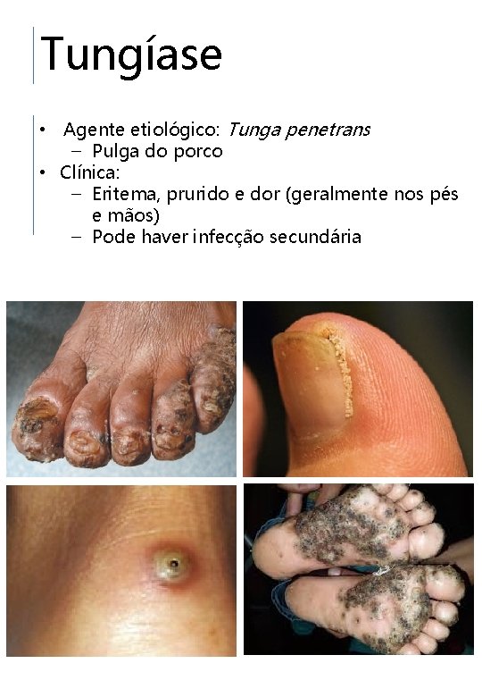 Tungíase • Agente etiológico: Tunga penetrans – Pulga do porco • Clínica: – Eritema,