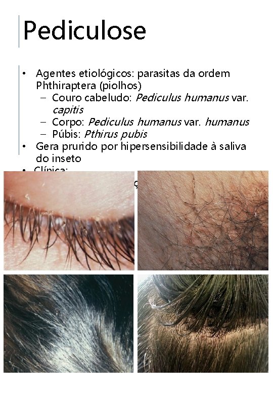 Pediculose • Agentes etiológicos: parasitas da ordem Phthiraptera (piolhos) – Couro cabeludo: Pediculus humanus
