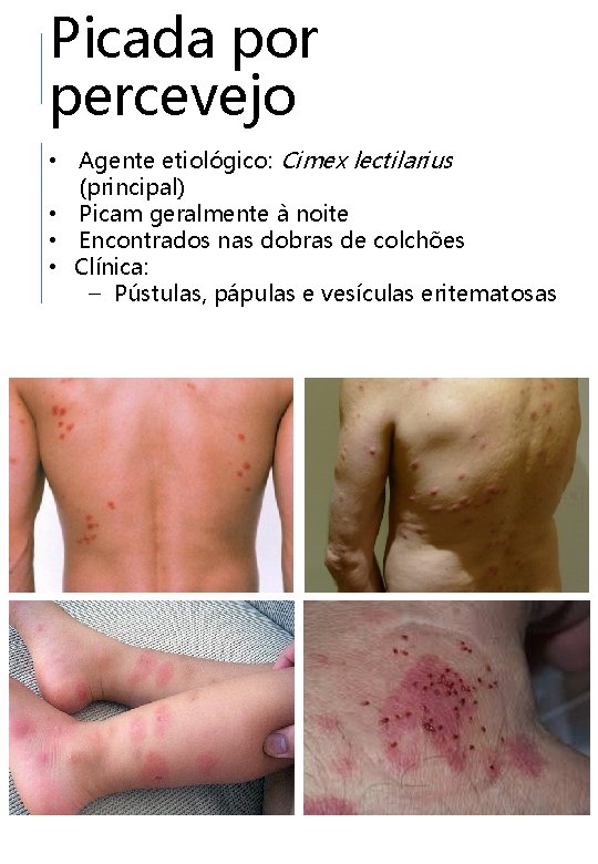 Picada por percevejo • Agente etiológico: Cimex lectilarius (principal) • Picam geralmente à noite