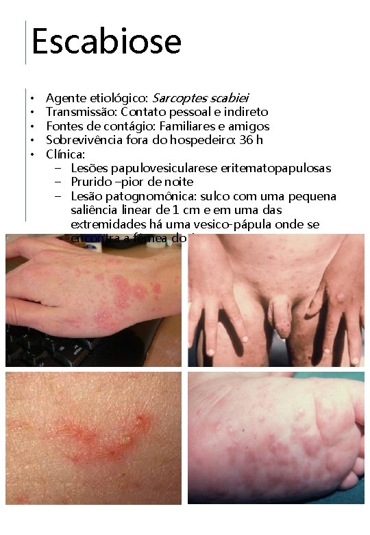 Escabiose • • • Agente etiológico: Sarcoptes scabiei Transmissão: Contato pessoal e indireto Fontes