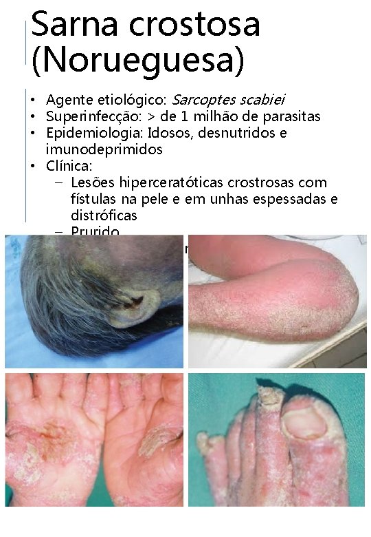 Sarna crostosa (Norueguesa) • Agente etiológico: Sarcoptes scabiei • Superinfecção: > de 1 milhão
