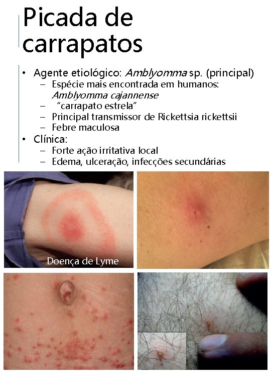 Picada de carrapatos • Agente etiológico: Amblyomma sp. (principal) – Espécie mais encontrada em